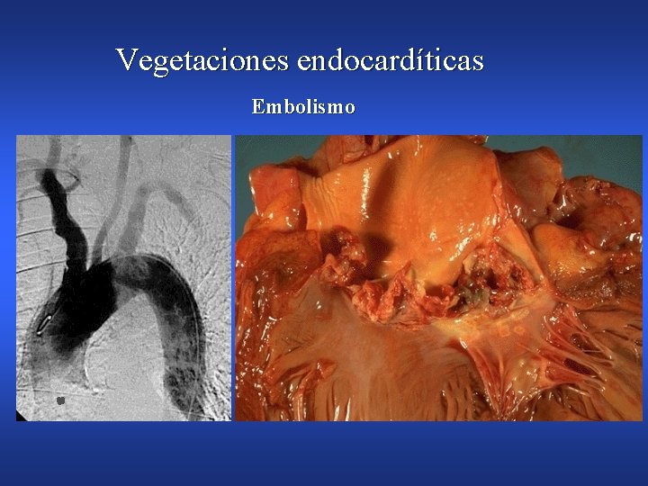 Vegetaciones endocardíticas Embolismo 