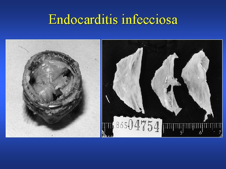 Endocarditis infecciosa 