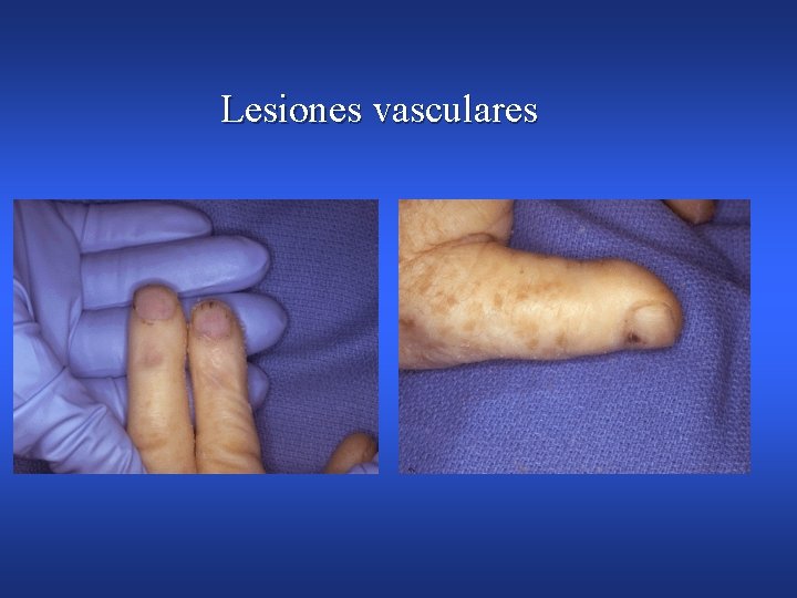 Lesiones vasculares 