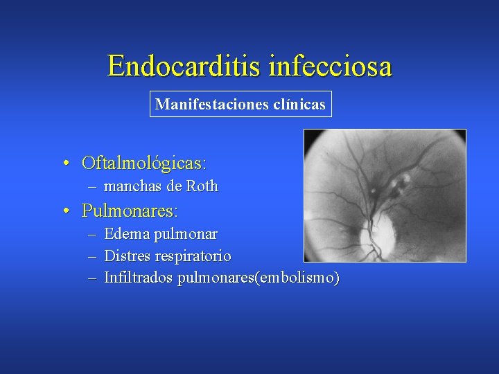 Endocarditis infecciosa Manifestaciones clínicas • Oftalmológicas: – manchas de Roth • Pulmonares: – Edema