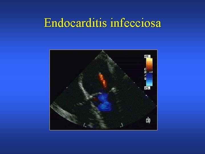 Endocarditis infecciosa 