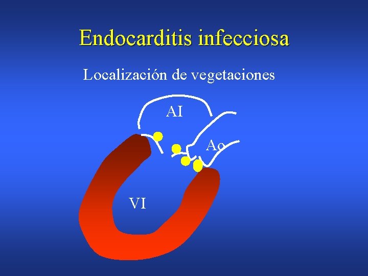 Endocarditis infecciosa Localización de vegetaciones AI Ao VI 