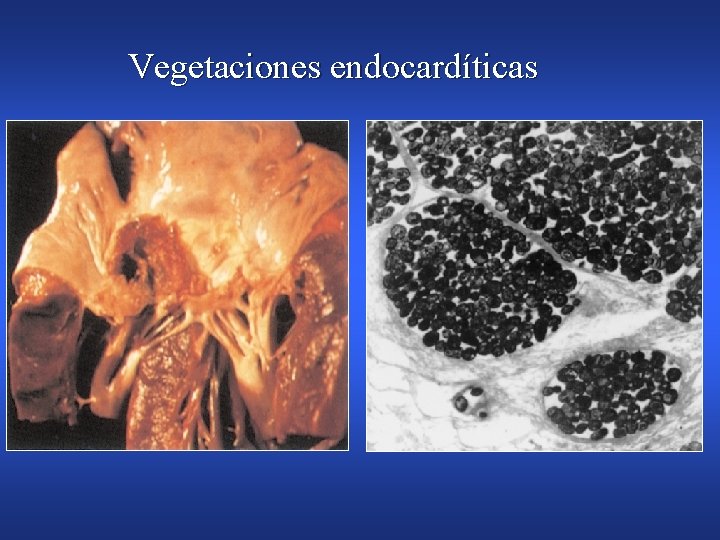 Vegetaciones endocardíticas 