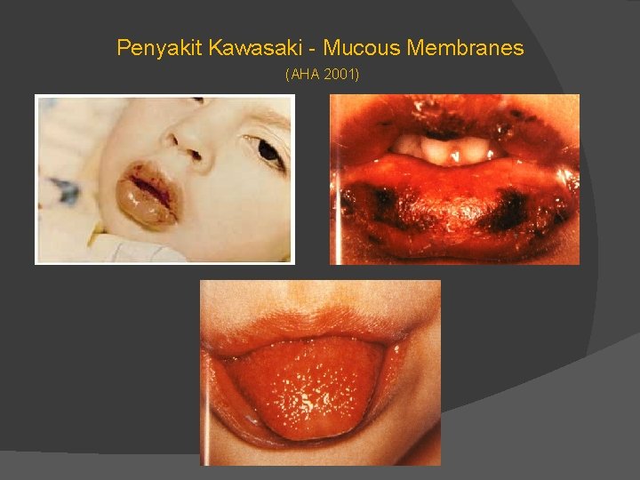 Penyakit Kawasaki - Mucous Membranes (AHA 2001) 