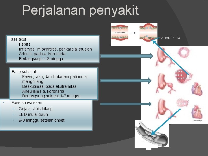 Perjalanan penyakit Fase akut Febris Inflamasi, miokarditis, perikardial efusion Arteritis pada a. koronaria Berlangsung