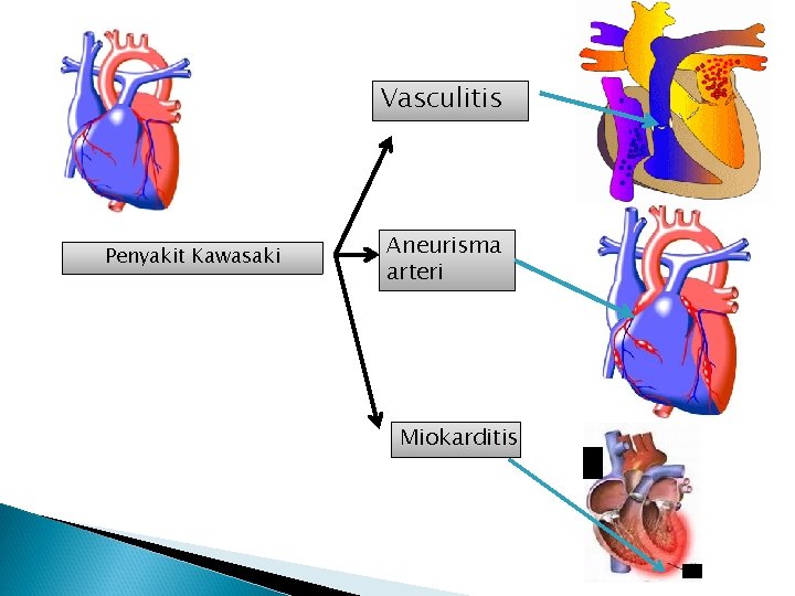 Vasculitis Penyakit Kawasaki Aneurisma arteri Miokarditis 