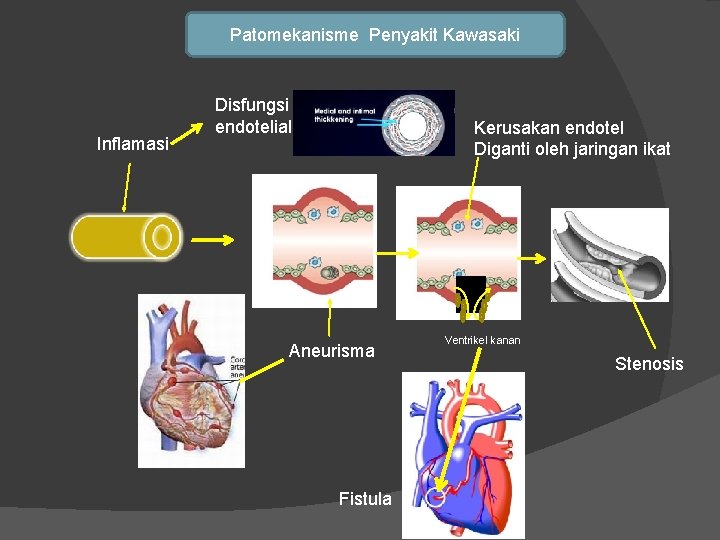 Patomekanisme Penyakit Kawasaki Inflamasi Disfungsi endotelial Kerusakan endotel Diganti oleh jaringan ikat Aneurisma Fistula