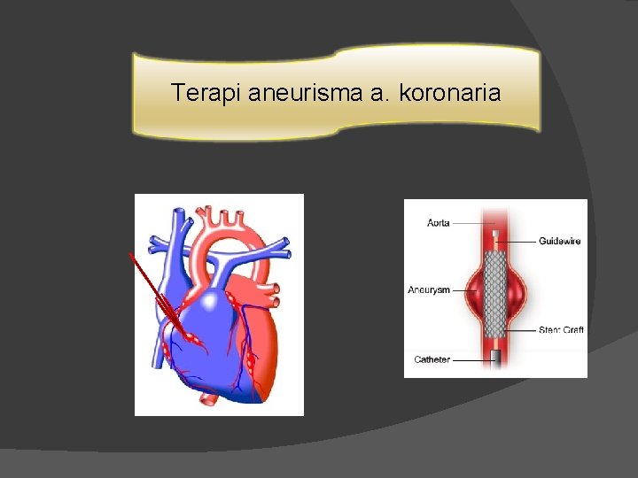 Terapi aneurisma a. koronaria 