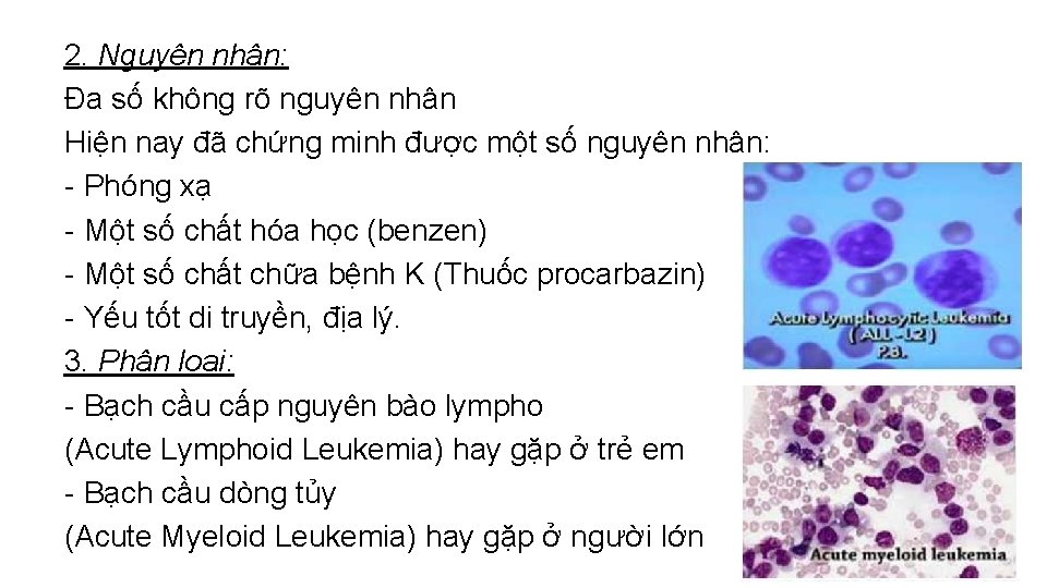 2. Nguyên nhân: Đa số không rõ nguyên nhân Hiện nay đã chứng minh