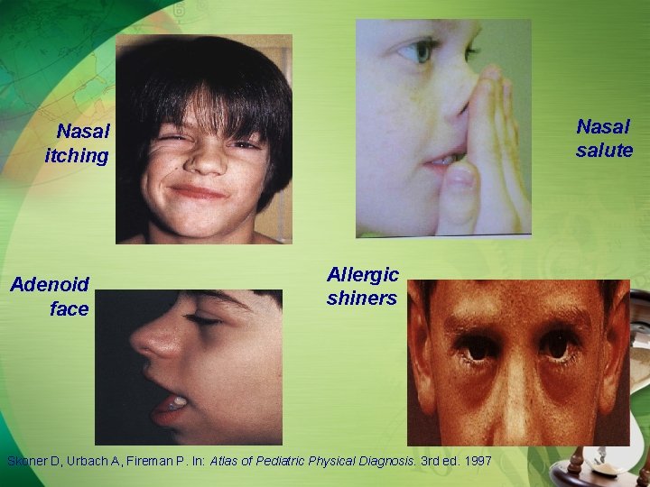 Nasal salute Nasal itching Adenoid face Allergic shiners Skoner D, Urbach A, Fireman P.