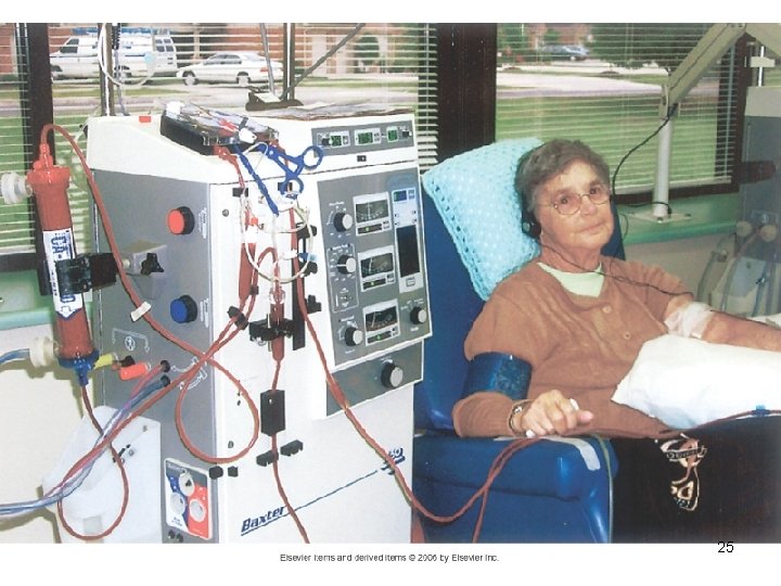 Complications of Hemodialysis Dialysis disequilibrium syndrome Ø Infectious diseases Ø Hepatitis B and C