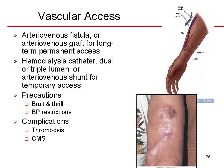 Vascular Access Ø Ø Ø Arteriovenous fistula, or arteriovenous graft for longterm permanent access