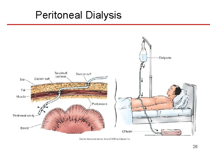 Peritoneal Dialysis 28 