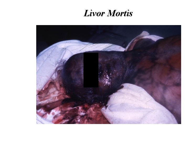 Livor Mortis Livor Mortis