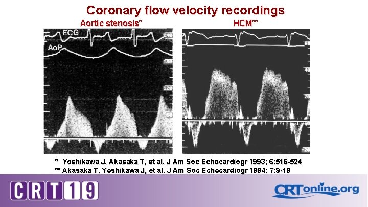 Coronary flow velocity recordings Aortic stenosis* HCM** * Yoshikawa J, Akasaka T, et al.
