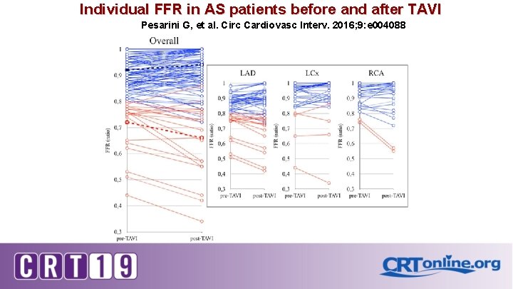 Individual FFR in AS patients before and after TAVI Pesarini G, et al. Circ