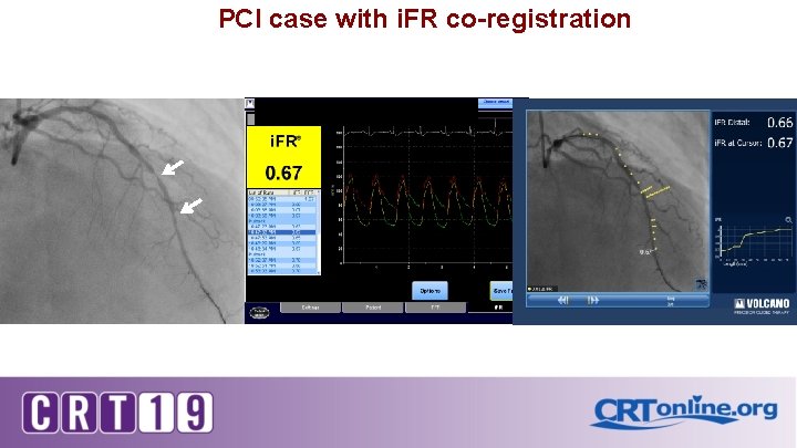 PCI case with i. FR co-registration 