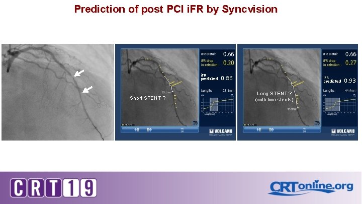 Prediction of post PCI i. FR by Syncvision i. FR predicted Short STENT ?