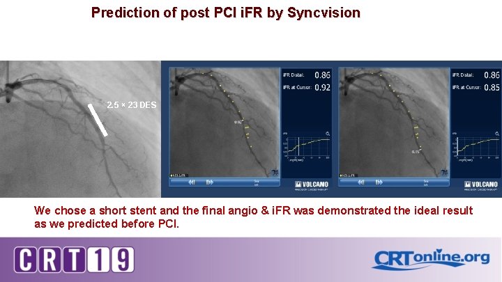 Prediction of post PCI i. FR by Syncvision 2. 5 × 23 DES We