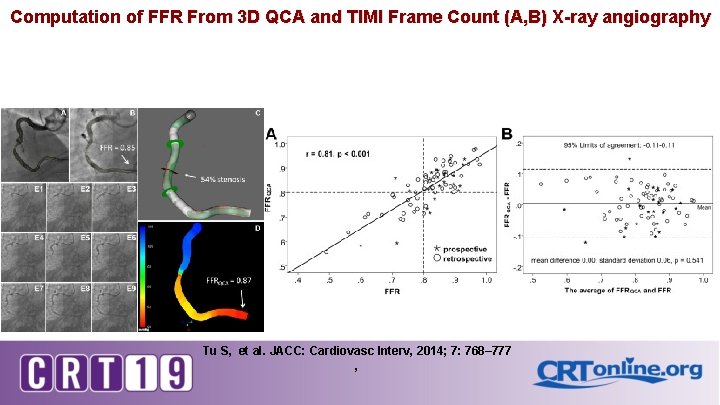 Computation of FFR From 3 D QCA and TIMI Frame Count (A, B) X-ray