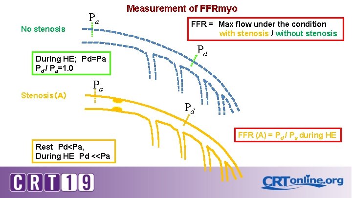 No stenosis Measurement of FFRmyo Pa FFR =　Max flow under the condition with stenosis