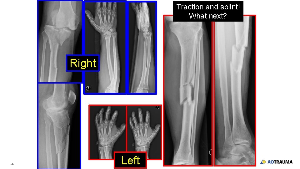 Traction and splint! What next? Right 10 Left Traction and splint! What next? Right 10 Left
