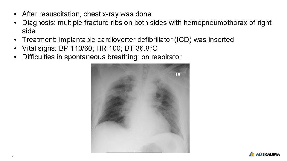 • After resuscitation, chest x-ray was done • Diagnosis: multiple fracture ribs on • After resuscitation, chest x-ray was done • Diagnosis: multiple fracture ribs on