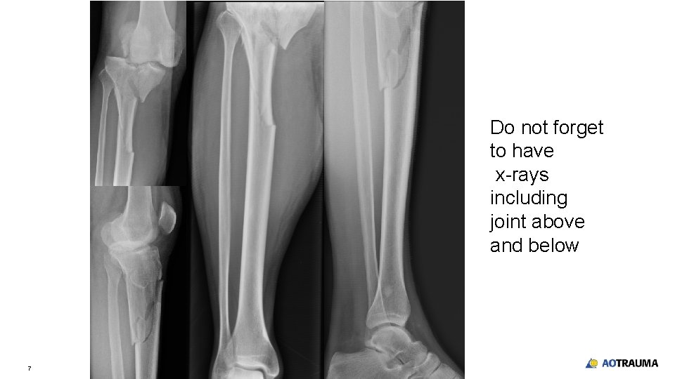 Do not forget to have x-rays including joint above and below 7 Do not forget to have x-rays including joint above and below 7