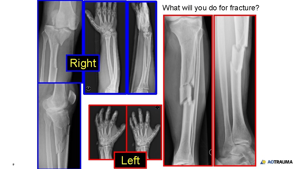 What will you do for fracture? Right 9 Left What will you do for fracture? Right 9 Left