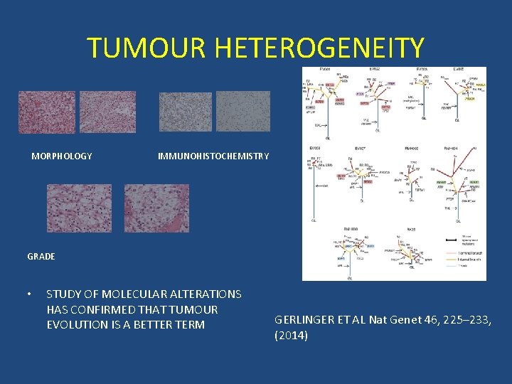 TUMOUR HETEROGENEITY MORPHOLOGY IMMUNOHISTOCHEMISTRY GRADE • STUDY OF MOLECULAR ALTERATIONS HAS CONFIRMED THAT TUMOUR