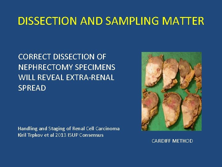 DISSECTION AND SAMPLING MATTER CORRECT DISSECTION OF NEPHRECTOMY SPECIMENS WILL REVEAL EXTRA-RENAL SPREAD Handling