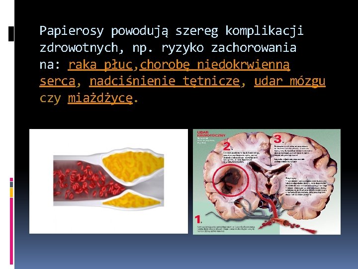 Papierosy powodują szereg komplikacji zdrowotnych, np. ryzyko zachorowania na: raka płuc, chorobę niedokrwienną serca,