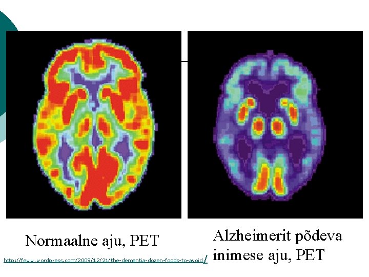 Normaalne aju, PET http: //feww. wordpress. com/2009/12/21/the-dementia-dozen-foods-to-avoid / Alzheimerit põdeva inimese aju, PET 