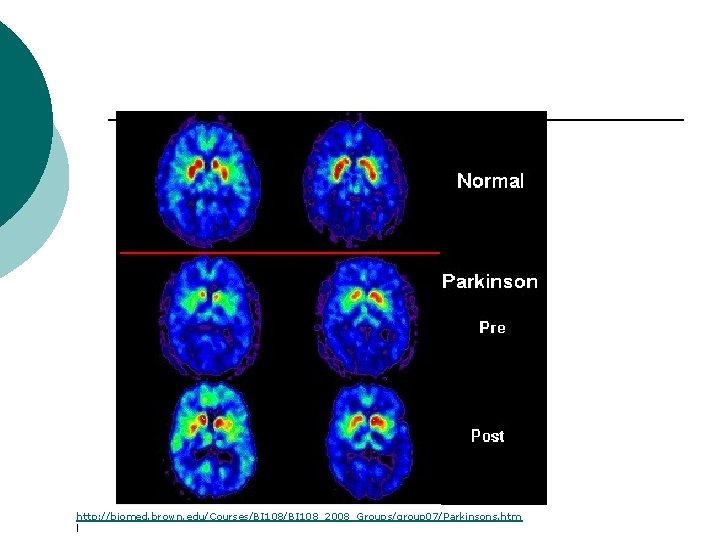 http: //biomed. brown. edu/Courses/BI 108_2008_Groups/group 07/Parkinsons. htm l 