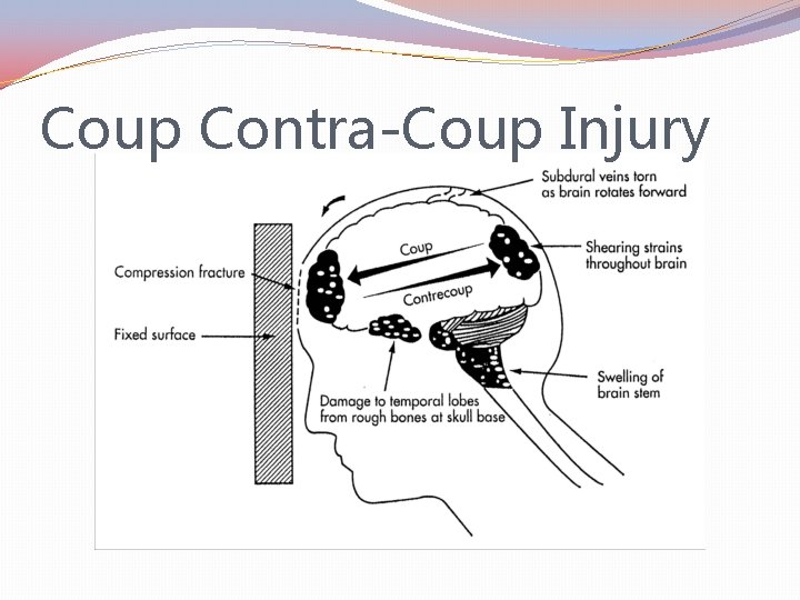 Coup Contra-Coup Injury 