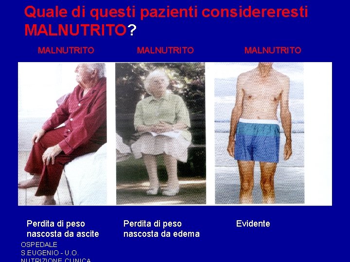 Quale di questi pazienti considereresti MALNUTRITO? MALNUTRITO Perdita di peso nascosta da ascite OSPEDALE Quale di questi pazienti considereresti MALNUTRITO? MALNUTRITO Perdita di peso nascosta da ascite OSPEDALE