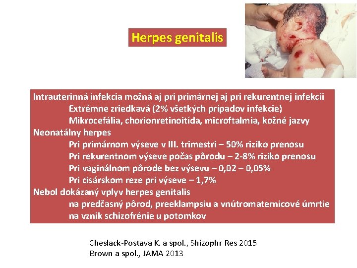 Herpes genitalis Intrauterinná infekcia možná aj primárnej aj pri rekurentnej infekcii Extrémne zriedkavá (2%