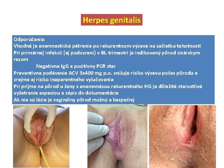 Herpes genitalis Odporúčania: Vhodné je anamnestické pátranie po rekurentnom výseve na začiatku tehotnosti Pri