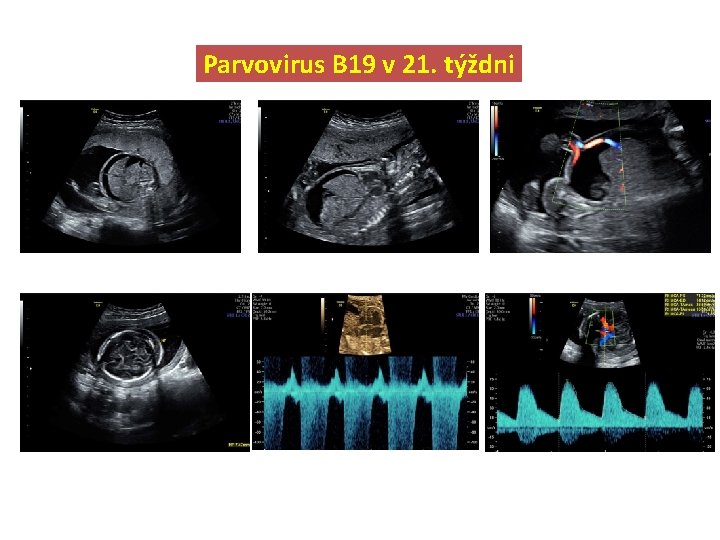 Parvovirus B 19 v 21. týždni 
