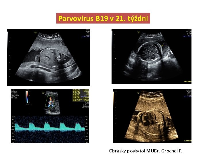 Parvovirus B 19 v 21. týždni Obrázky poskytol MUDr. Grochál F. 