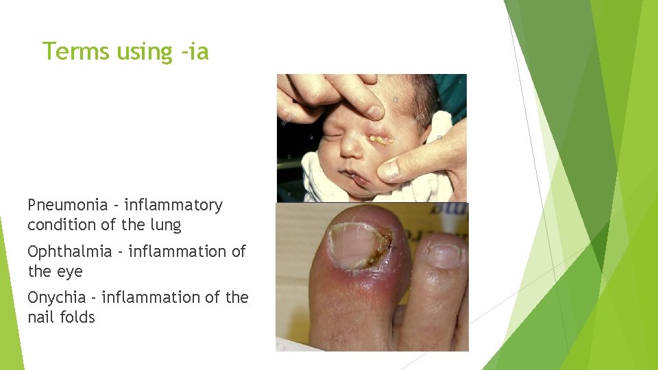 Terms using -ia Pneumonia - inflammatory condition of the lung Ophthalmia - inflammation of Terms using -ia Pneumonia - inflammatory condition of the lung Ophthalmia - inflammation of