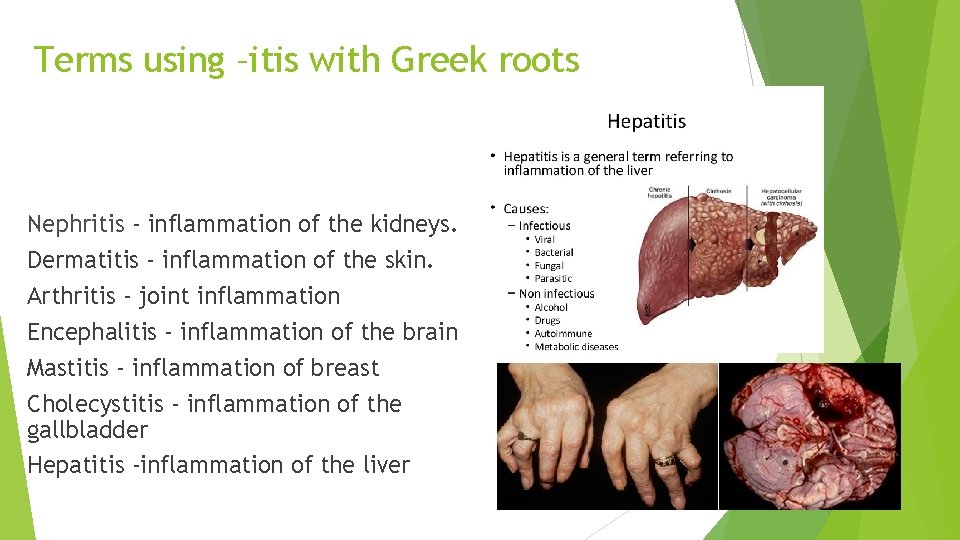 Terms using –itis with Greek roots Nephritis - inflammation of the kidneys. Dermatitis - Terms using –itis with Greek roots Nephritis - inflammation of the kidneys. Dermatitis -