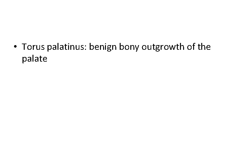  • Torus palatinus: benign bony outgrowth of the palate 