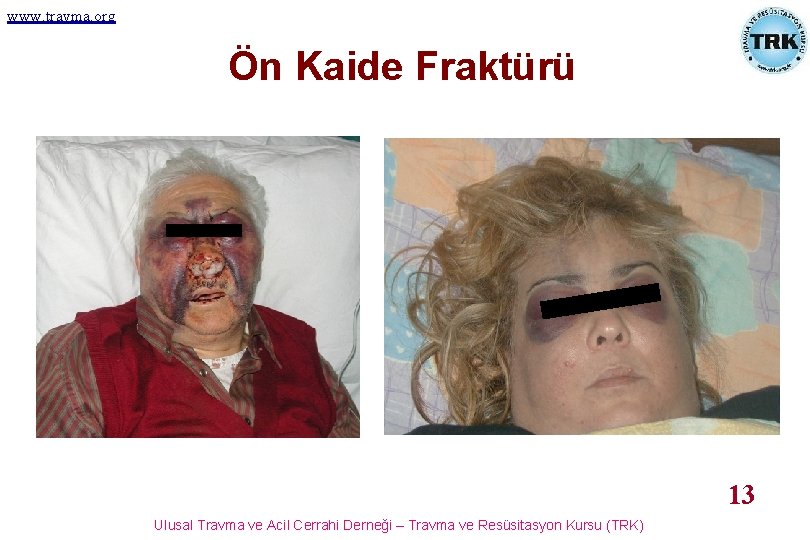 www. travma. org Ön Kaide Fraktürü 13 Ulusal Travma ve Acil Cerrahi Derneği –