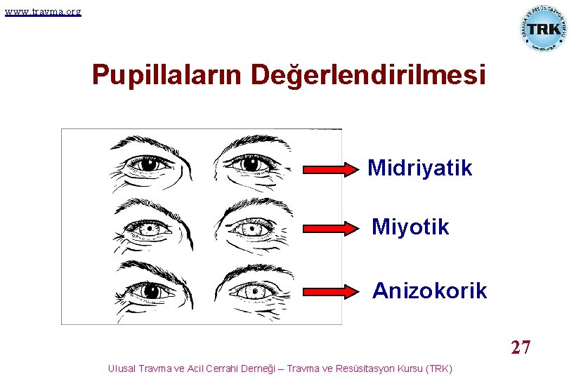 www. travma. org Pupillaların Değerlendirilmesi Midriyatik Miyotik Anizokorik 27 Ulusal Travma ve Acil Cerrahi