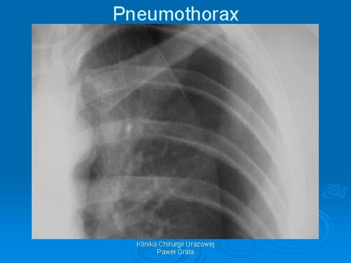 Pneumothorax Klinika Chirurgii Urazowej Paweł Grala 