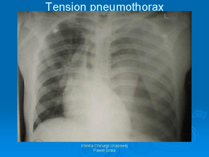 Tension pneumothorax Klinika Chirurgii Urazowej Paweł Grala 
