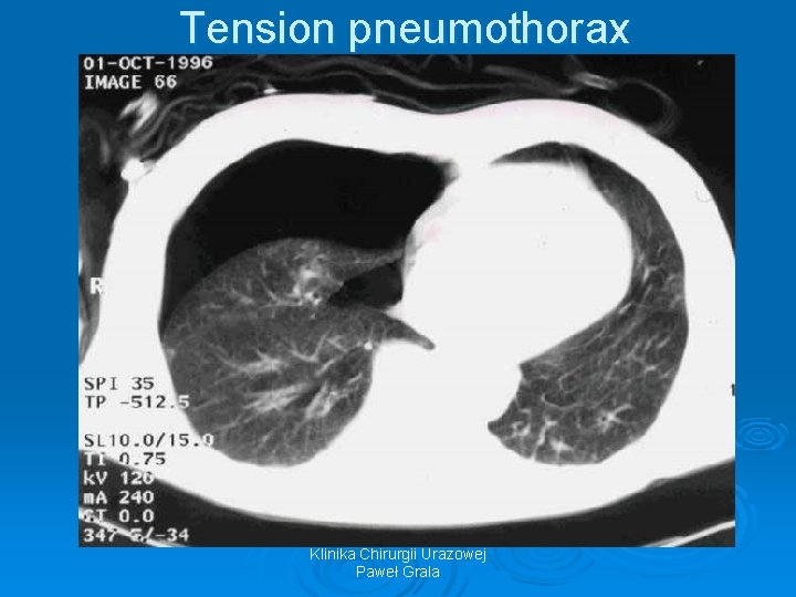 Tension pneumothorax Klinika Chirurgii Urazowej Paweł Grala 