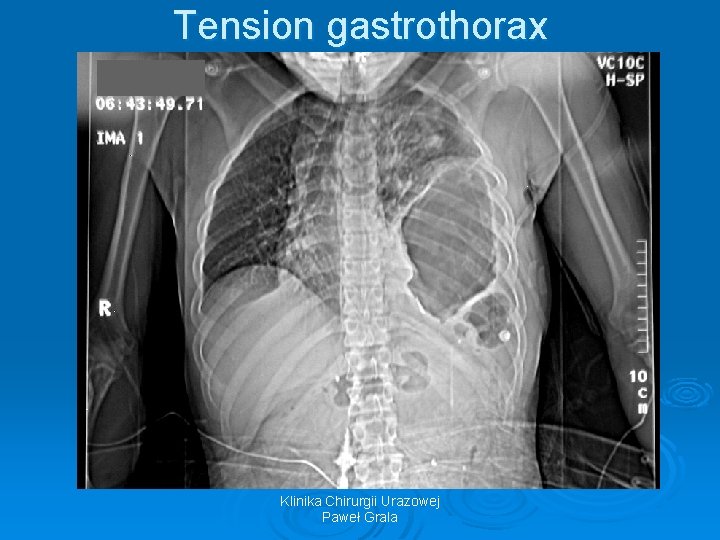 Tension gastrothorax Klinika Chirurgii Urazowej Paweł Grala 