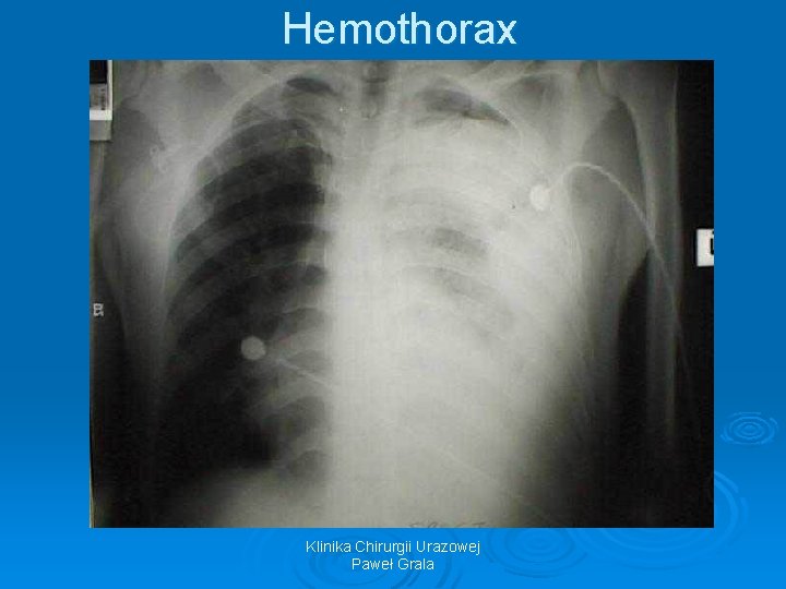 Hemothorax Klinika Chirurgii Urazowej Paweł Grala 
